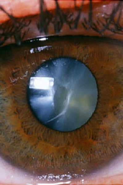 ಕಣ್ಣಿನ ಪೊರಕಣ್ಣಿನ ಪೊರೆ ಕಾಟರಾಕ್ಟ್ಬಗ್ಗೆ ವಿಶ್ಲೇಷಣೆ ನಿಮಗಾಗಿ