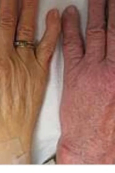 पारनिसियस एनीमिया ( Pernicious anemia )